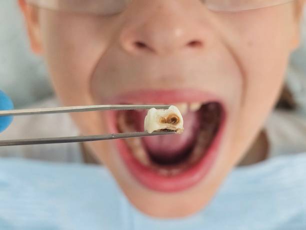 Best Emergency Tooth Extraction in Piney Green, NC